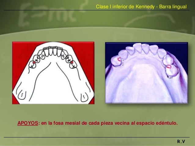 Diseño de protesis parcial removible
