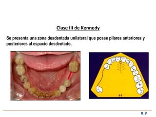 Diseño de protesis parcial removible | PPTX