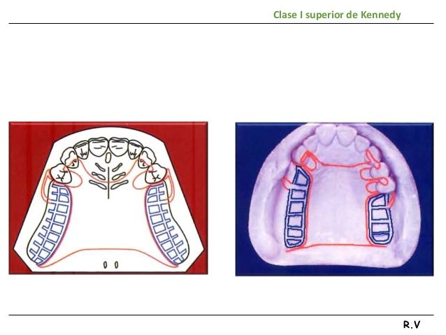 Clase 1 De Kennedy Inferior Diseño