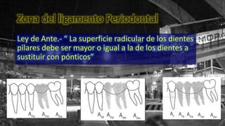 Zona del ligamento Periodontal
Ley de Ante.- “ La superficie radicular de los dientes
pilares debe ser mayor o igual a la de los dientes a
sustituir con pónticos”
 
