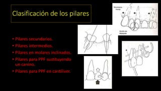 Clasificación de los pilares
• Pilares secundarios.
• Pilares intermedios.
• Pilares en molares inclinados.
• Pilares para PPF sustituyendo
un canino.
• Pilares para PPF en cantiliver.
 