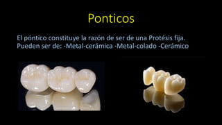 Ponticos
El póntico constituye la razón de ser de una Protésis fija.
Pueden ser de: -Metal-cerámica -Metal-colado -Cerámico
 