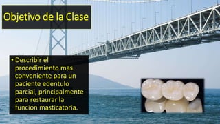 Objetivo de la Clase
• Describir el
procedimiento mas
conveniente para un
paciente edentulo
parcial, principalmente
para restaurar la
función masticatoria.
 
