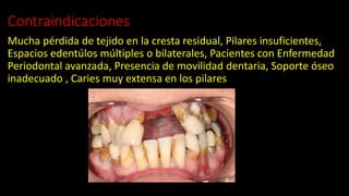 Contraindicaciones
Mucha pérdida de tejido en la cresta residual, Pilares insuficientes,
Espacios edentúlos múltiples o bilaterales, Pacientes con Enfermedad
Periodontal avanzada, Presencia de movilidad dentaria, Soporte óseo
inadecuado , Caries muy extensa en los pilares
 