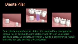 Es un diente natural que se utiliza, si la proporción y configuración
corona-raíz es adecuada, para sostener una PPF con un espacio
edentúlo corto. Da soporte, retención y ayuda a equilibrar las fuerzas
ejercidas por ésta durante la masticación.
 