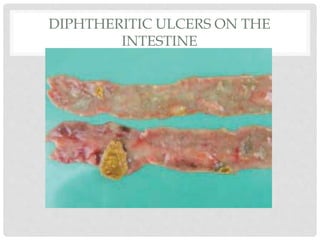 DIPHTHERITIC ULCERS ON THE
INTESTINE
 