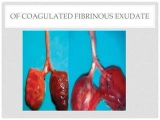 OF COAGULATED FIBRINOUS EXUDATE
 