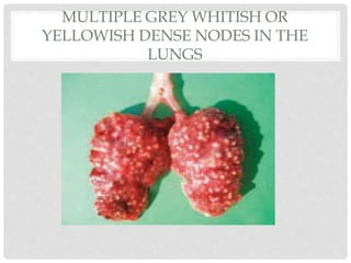 MULTIPLE GREY WHITISH OR
YELLOWISH DENSE NODES IN THE
LUNGS
 