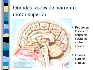 Grandes lesões de neurônio motor superior Pequenas lesões de corpo de neurônio motor inferior Lesões axonais difusas 