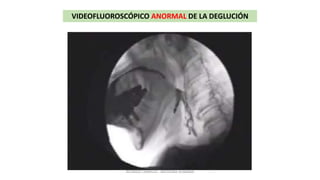 VIDEOFLUOROSCÓPICO ANORMAL DE LA DEGLUCIÓN
RICARDO CARRILLO - MEDICINA HUMANA
 