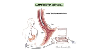 Catéter de presión en luz esofágica
Sistema de manomestría
5 cm
EEI
LA MANOMETRIA ESOFAGICA
 