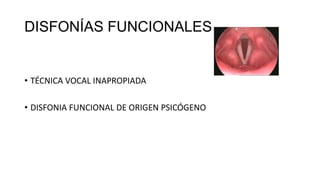 DISFONÍAS FUNCIONALES
• TÉCNICA VOCAL INAPROPIADA
• DISFONIA FUNCIONAL DE ORIGEN PSICÓGENO
 