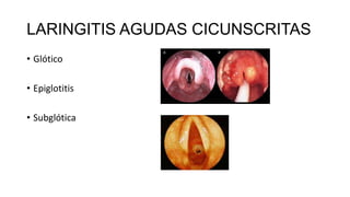 LARINGITIS AGUDAS CICUNSCRITAS
• Glótico
• Epiglotitis
• Subglótica
 