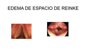 EDEMA DE ESPACIO DE REINKE
 