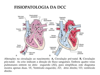 Alterações na circulação ao nascimento. A, Circulação pré-natal. B, Circulação
pós-natal. As setas indicam a direção do fluxo sanguíneo. Embora quatro veias
pulmonares entrem no átrio esquerdo (AE), para simplificar, este diagrama
mostra apenas duas. VE, Ventrículo esquerdo; AD, átrio direito; VD, ventrículo
direito.
FISIOPATOLOGIA DA DCC
 