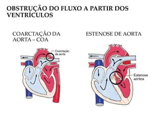 OBSTRUÇÃO DO FLUXO A PARTIR DOS
VENTRÍCULOS
COARCTAÇÃO DA
AORTA – COA
ESTENOSE DE AORTA
 