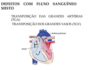 DEFEITOS COM FLUXO SANGUÍNEO
MISTO
TRANSPOSIÇÃO DAS GRANDES ARTÉRIAS
(TGA)
TRANSPOSIÇÃO DOS GRANDES VASOS (TGV)
 