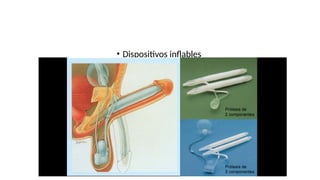 • Dispositivos inflables
 