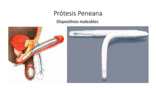 Dispositivos maleables
Prótesis Peneana
 