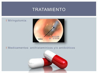  Miringotomía:
 Medicamentos: antihistamínicos y/o antibióticos
TRATAMIENTO
 