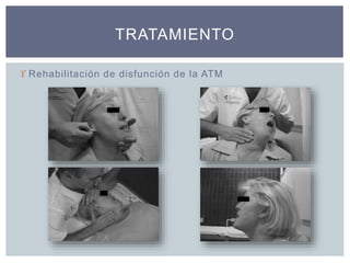  Rehabilitación de disfunción de la ATM
TRATAMIENTO
 