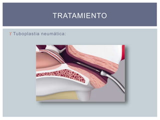  Tuboplastia neumática:
TRATAMIENTO
 