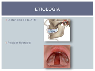  Disfunción de la ATM:
 Paladar fisurado:
ETIOLOGÍA
 