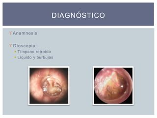  Anamnesis
 Otoscopia:
 Tímpano retraído
 Líquido y burbujas
DIAGNÓSTICO
 