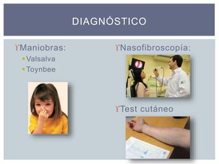 Maniobras:
Valsalva
Toynbee
Nasofibroscopía:
Test cutáneo
DIAGNÓSTICO
 