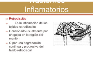 Trastornos
Inflamatorios







Retrodiscitis
Es la inflamación de los
tejidos retrodiscales
Ocasionado usualmente por
un golpe en la región del
mentón
O por una degradación
continua y progresiva del
tejido retrodiscal

 