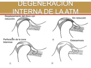 Desplazamiento del disco con
reducción.

Perforación de la zona
bilaminar.

Sin reducción

Osteoartrosis

 