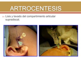 

Lisis y lavado del compartimiento articular
supradiscal.

 