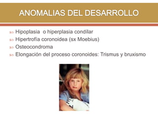 




Hipoplasia o hiperplasia condílar
Hipertrofía coronoidea (sx Moebius)
Osteocondroma
Elongación del proceso coronoides: Trismus y bruxismo

 
