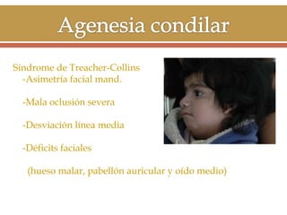 Síndrome de Treacher-Collins
-Asimetría facial mand.
-Mala oclusión severa
-Desviación línea media
-Déficits faciales

(hueso malar, pabellón auricular y oído medio)

 