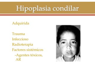 Adquirida
Trauma
Infeccioso
Radioterapia
Factores sistémicos
-Agentes tóxicos,
AR

 