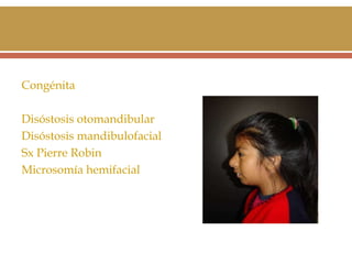 Congénita
Disóstosis otomandibular
Disóstosis mandibulofacial
Sx Pierre Robin
Microsomía hemifacial

 