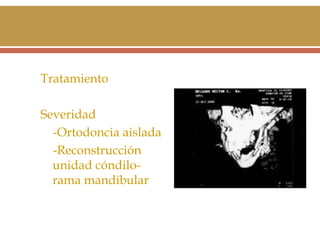 Tratamiento
Severidad
-Ortodoncia aislada
-Reconstrucción
unidad cóndilorama mandibular

 