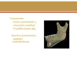 Tratamiento
-Activa (artrotomía y
resección condilar)
*Condilectomía alta.
-Inactiva (osteotomías
sagitales
mandibulares)

 
