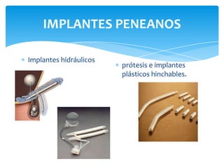 IMPLANTES PENEANOS

Implantes hidráulicos
                        prótesis e implantes
                        plásticos hinchables.
 