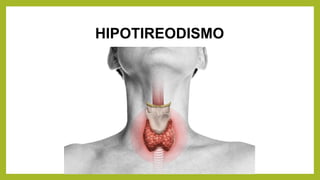 HIPOTIREODISMO
 