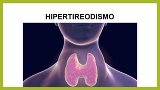 HIPERTIREODISMO
 