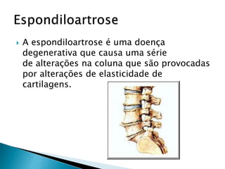  A espondiloartrose é uma doença
degenerativa que causa uma série
de alterações na coluna que são provocadas
por alterações de elasticidade de
cartilagens.
 