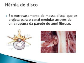  É o extravasamento de massa discal que se
projeta para o canal medular através de
uma ruptura da parede do anel fibroso.
 