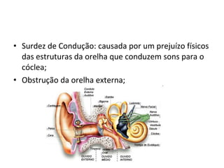 Surdez de Condução: causada por um prejuízo físicos das estruturas da orelha que conduzem sons para o cóclea; Obstrução da orelha externa; 