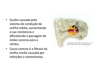 Surdez causada pelo sistema de condução da orelha média, aumentando a sua resistencia e dificultando a passagem de ondas sonoras para a cóclea; Causa comum é a fibrose da orelha media causada por infecções e osteoclerose. 