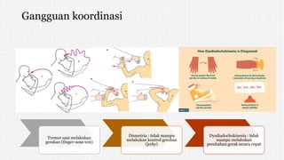 Gangguan koordinasi
Tremor saat melakukan
gerakan (finger-nose test)
Dismetria : tidak mampu
melakukan kontrol gerakan
(jerky)
Dysdiadochokinesia : tidak
mampu melakukan
perubahan gerak secara cepat
 