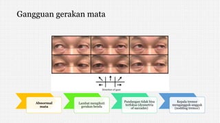 Gangguan gerakan mata
Abnormal
mata
Lambat mengikuti
gerakan benda
Pandangan tidak bisa
terfokus (dysmetria
of saccades)
Kepala tremor
mengangguk-angguk
(nodding tremor)
 