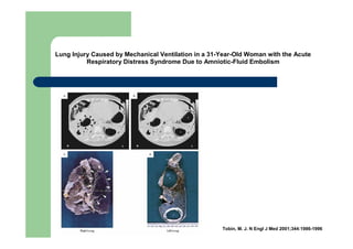 Lung Injury Caused by Mechanical Ventilation in a 31-Year-Old Woman with the Acute
          Respiratory Distress Syndrome Due to Amniotic-Fluid Embolism




                                                     Tobin, M. J. N Engl J Med 2001;344:1986-1996
 