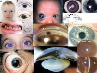 Disgenesias segmento anterior lml | PPT