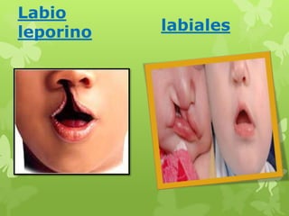 Labio 
leporino labiales 
 